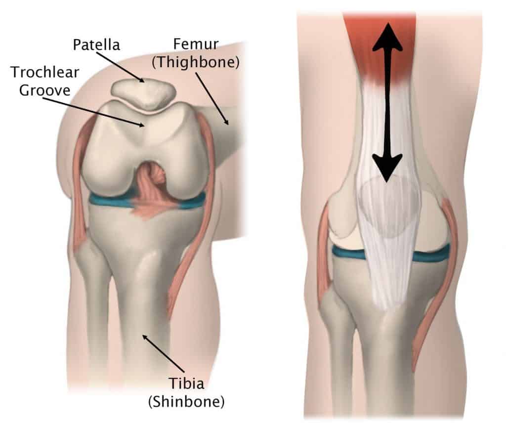 Patellofemoral pain is caused by an increase in forces at the patellofemoral joint where the patella sits within the trochlear groove.