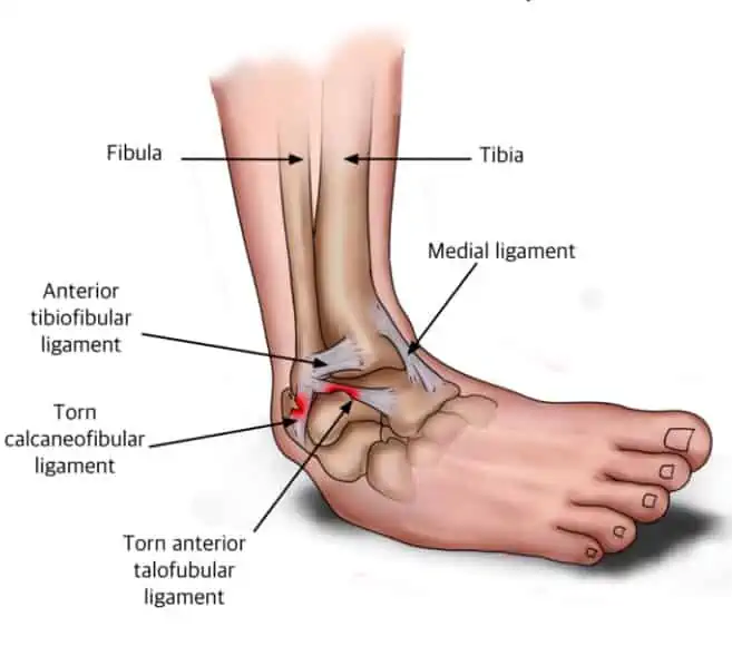 ankle sprains