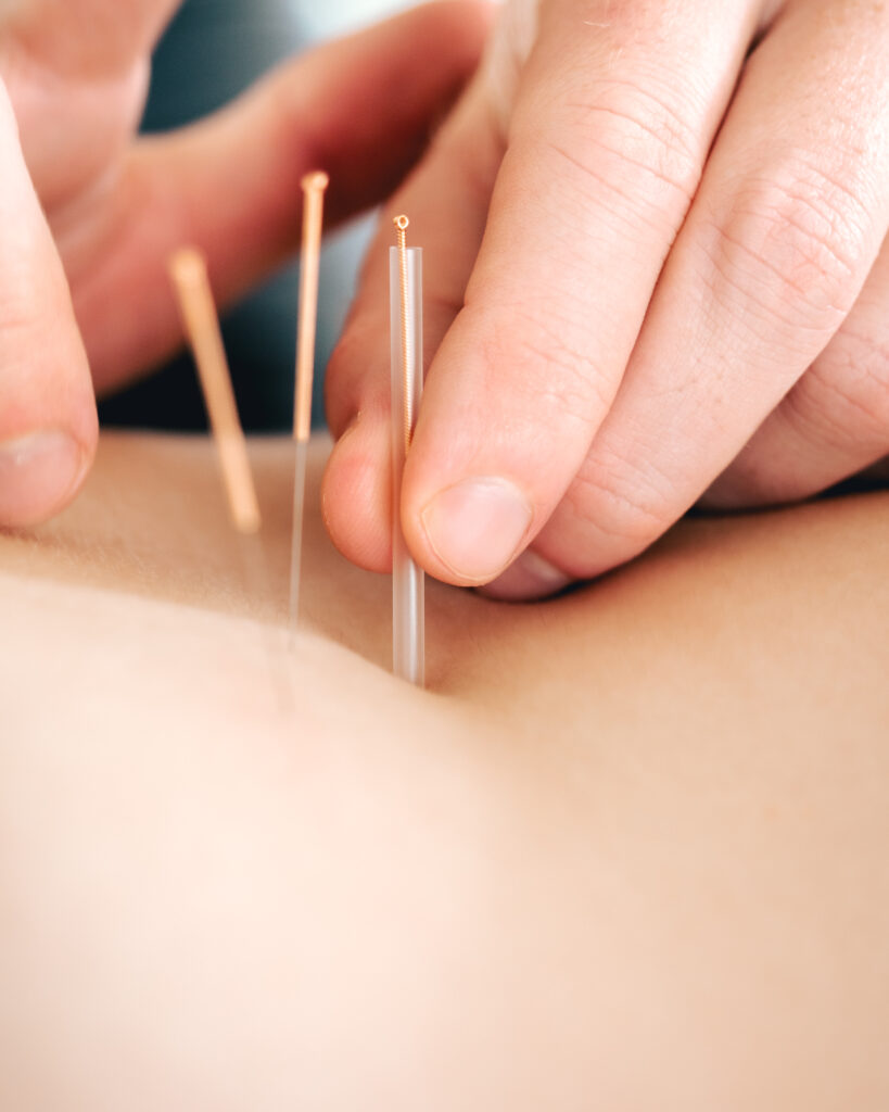 Close-up of dry needling treatment