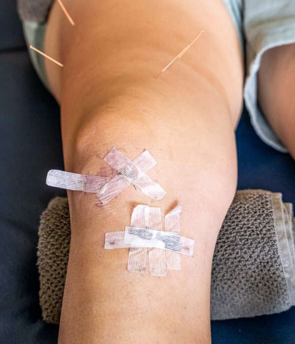 Dry needling of the quadriceps for a client recovering from ACL reconstruction.